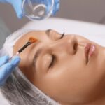 Chemical Skin Peels in Islamabad