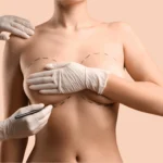 Breast Enlargement In Dubai