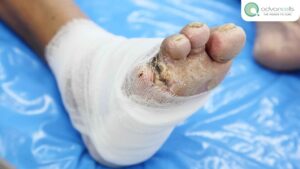 Critical-Limb-Ischemia