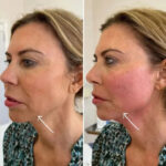Best Plastic Surgeons in dubai Enhancing Skin with Endolift Laser Technology