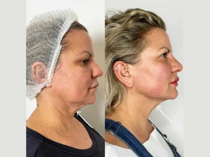 Best Aesthetic Clinics in dubai for Jawline Sculpting with Endolift