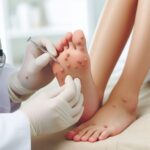 Warts Removal in Islamabad