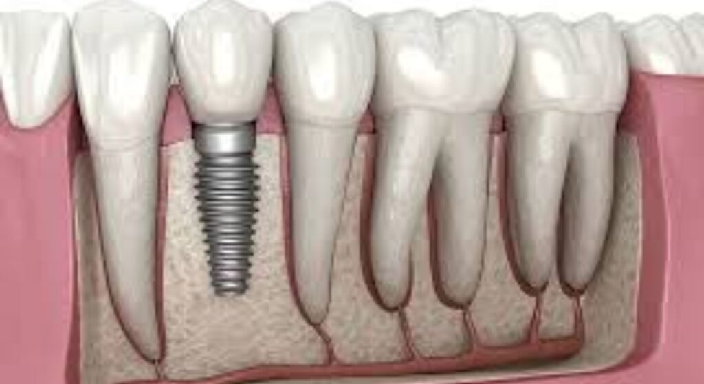 dental implants image