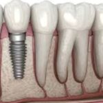 dental implants image