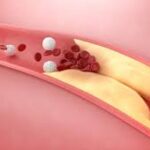 High cholesterolemia Dubai