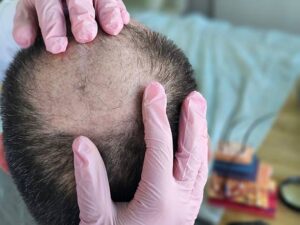 A Complete Guide to Scalp Micropigmentation Treatment in Islamabad