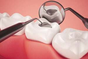 Get a Healthy Smile with Dental Fillings in Islamabad