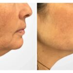 Best Aesthetic Clinics in Dubai for Advanced Anti Aging Thread Lift Treatments