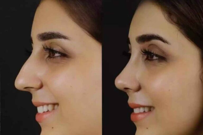 Septoplasty in Dubai