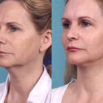 Chemical Peel in Dubai