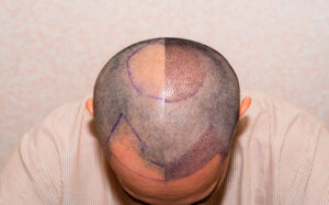 Hair transplant cost