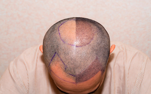 Hair transplant cost