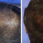زراعة الشعر في دبي