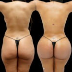 fat transfer in dubai