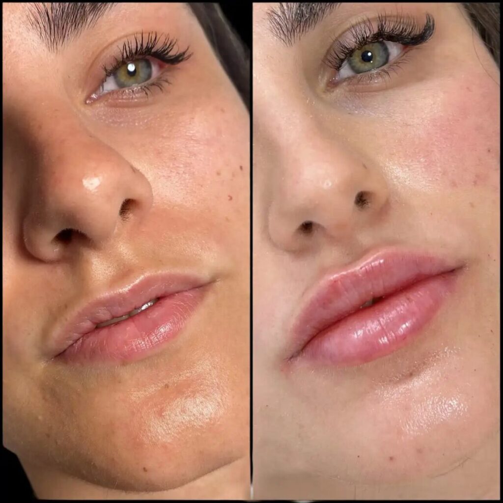 fillers