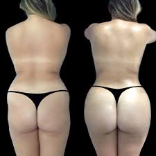 butt fat transfer cost