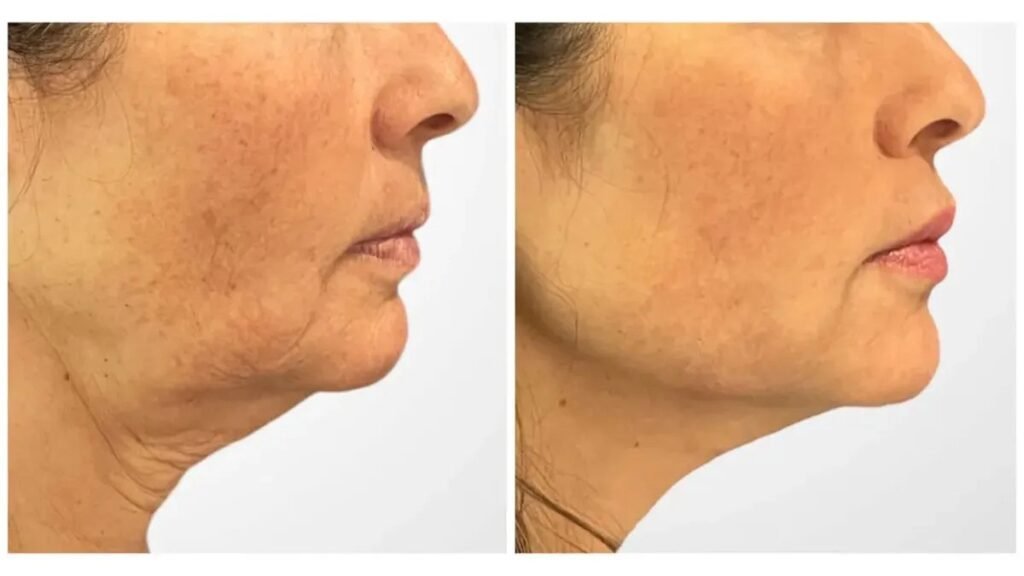 Best Aesthetic Clinic in Dubai Offer Thread Lift For Youthful Skin