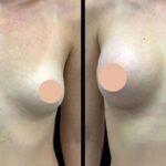 Best Breast Augmentation Surgeon in Dubai for Beautiful Results