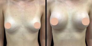 Best Breast Augmentation Surgeon in Dubai for Beautiful Results