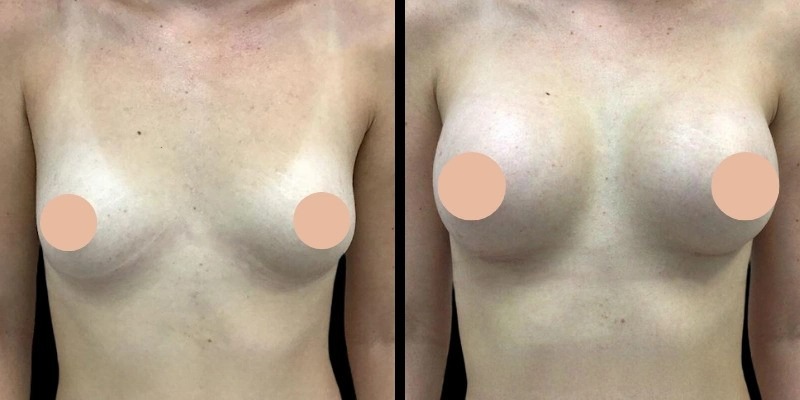 Best Breast Augmentation Surgeon in Dubai for Beautiful Results