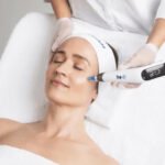 microneedling edmonton alberta
