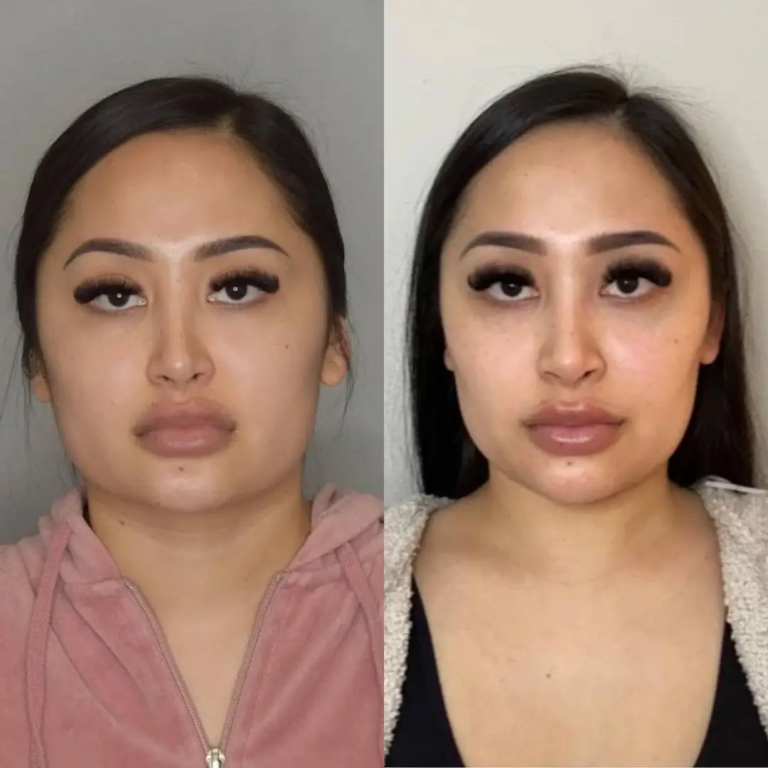 Buccal Fat Removal in Dubai