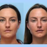 Thread lift treatments in Dubai Delivering Safe Beautiful Facial Enhancement Results