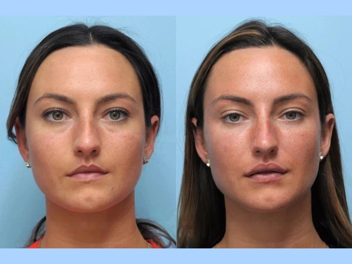 Thread lift treatments in Dubai Delivering Safe Beautiful Facial Enhancement Results