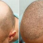 زراعة الشعر في الرياض