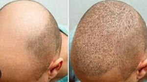 زراعة الشعر في الرياض