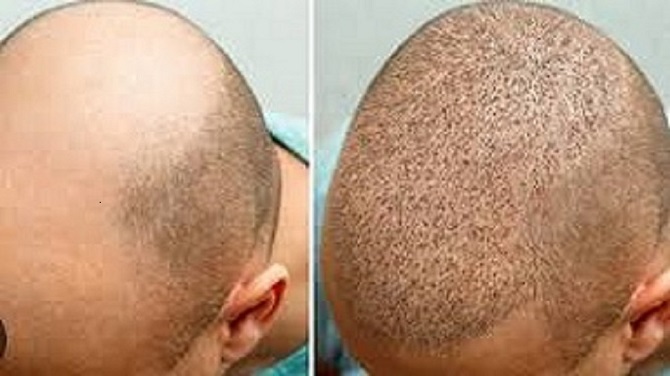 زراعة الشعر في الرياض