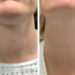 Best Aesthetic Clinics in dubai Offering Radiofrequency (RF) Microneedling