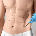 Liposuction in Dubai