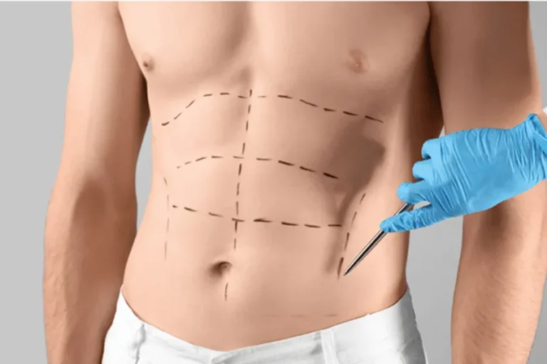 Liposuction in Dubai