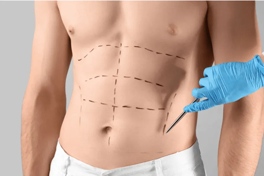 Liposuction in Dubai