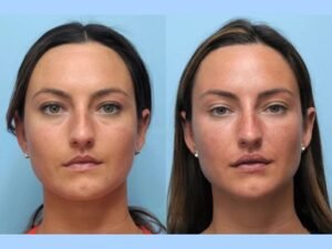 Best Aesthetic Clinic in Dubai Offering Reliable Thread Lift Procedures