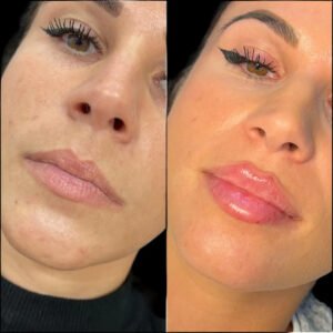 fillers