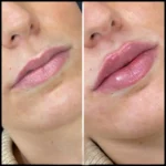 dermal fillers