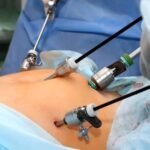Laparoscopic Surgery in Islamabad