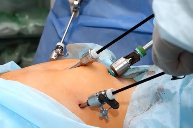 Laparoscopic Surgery in Islamabad