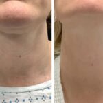 Best Doctors in dubai for Acne Scar Radiofrequency Microneedling