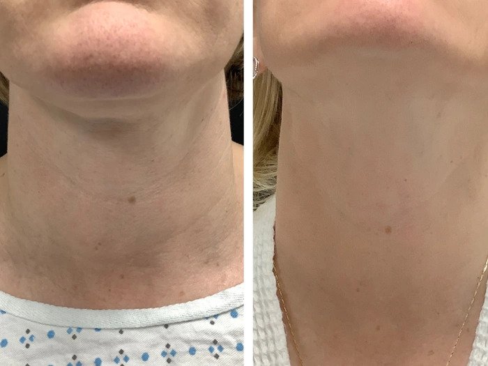 Best Doctors in dubai for Professional Radiofrequency Microneedling Care