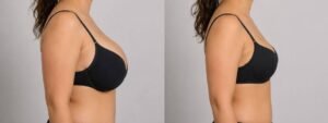 Breast Augmentation in Dubai