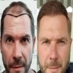 تكلفة زراعة الشعر في الرياض