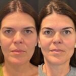 Best Plastic Surgeon in Dubai Specializing in Safe Thread Lift Procedures