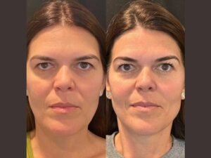 Best Plastic Surgeon in Dubai Specializing in Safe Thread Lift Procedures