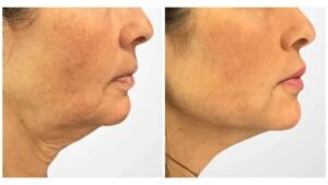 Best Plastic Surgeons in Dubai: Advanced Beauty Enhancement Through Thread Lift Solutions
