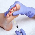 Botox for Foot Sweating in Dubai3