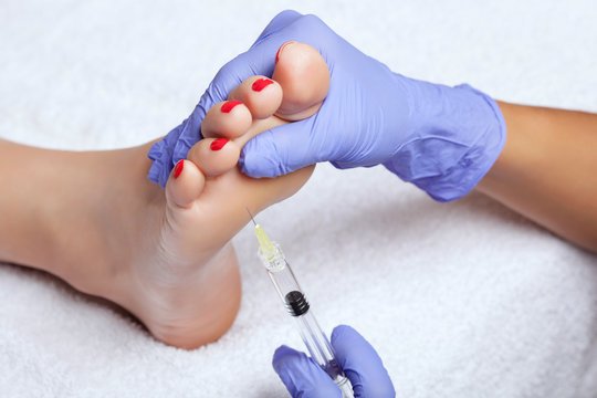 Botox for Foot Sweating in Dubai3