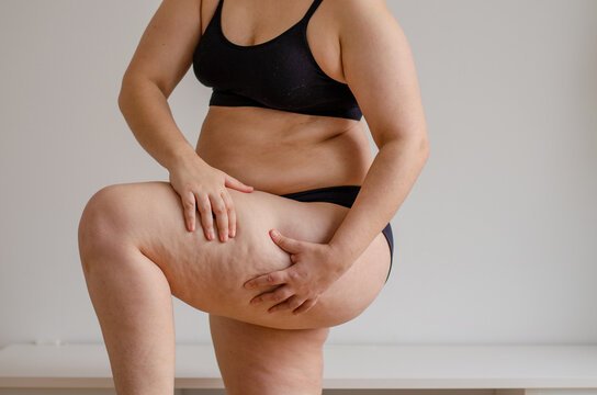 Fat Injections in Dubai